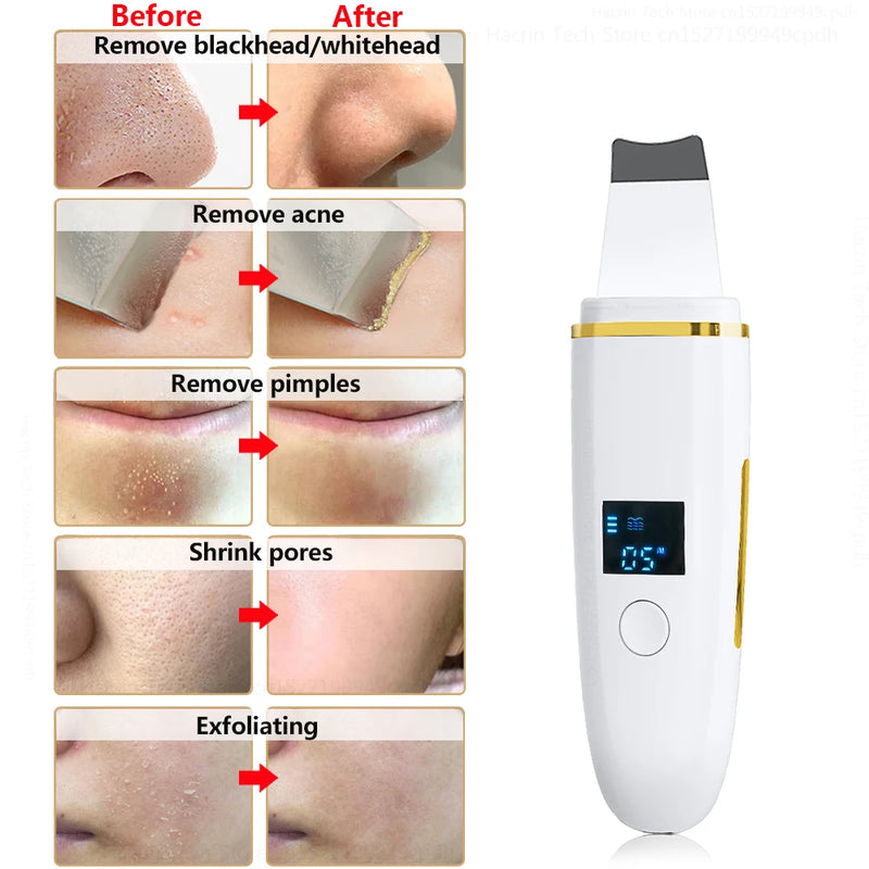 Ultrasonic Skin Scrubber Remover